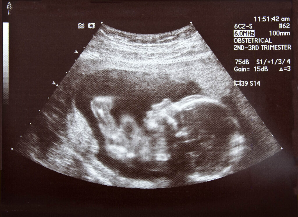 An ultrasound of a human fetus during the 17th week.
